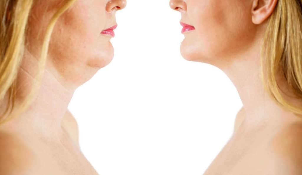 Double Chin treatment Cockfosters before and after results