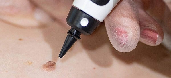 After Skin Tag Removal Cockfosters