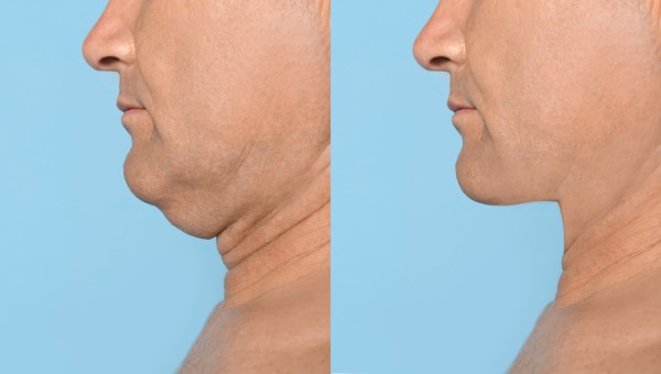 Which Non-Surgical Treatments Work Best for Jowls and Loose Skin Cockfosters?