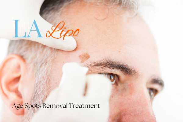 What Are the Most Effective Treatments for Age Spots Cockfosters?