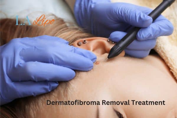 Dermatofibroma Removal Treatment Cockfosters