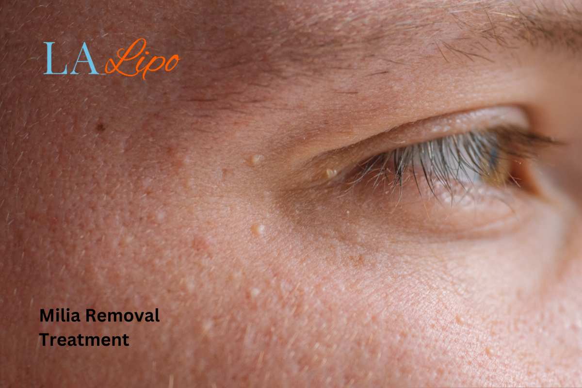 Cryopen Milia Removal: Is It the Easiest and Safest Option Cockfosters?