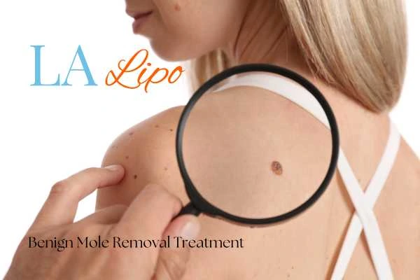 Woman having her inspection of blemish before mole removal Cockfosters