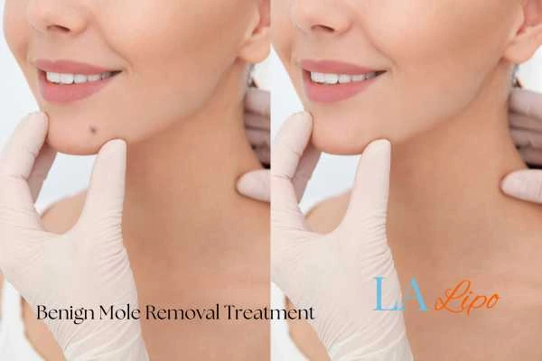 Before and after mole removal Cockfosters treatment