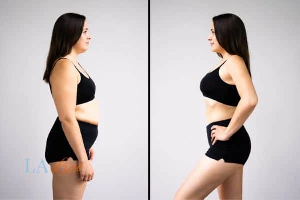 image of woman before and after results of LA-EMS Body Sculpting Cockfosters to help treat Diastasis recti