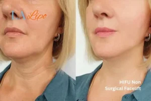 hi-fu for wrinkles Cockfosters before and after results