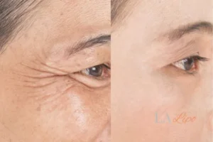 Before and after results of woman - HI-fu wrinkles reduction treatment Cockfosters