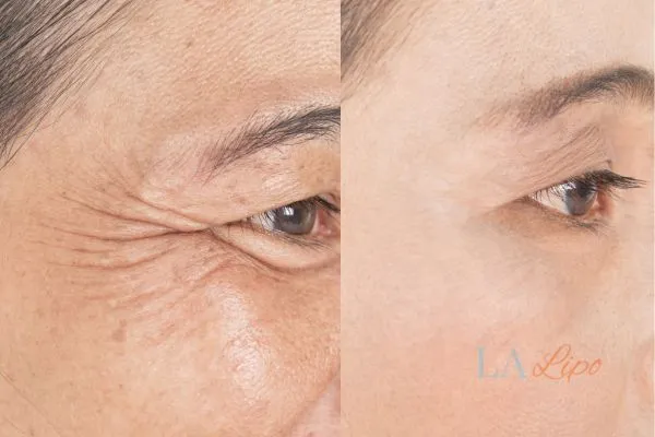 Before and after results of woman - HI-fu wrinkles reduction treatment Cockfosters