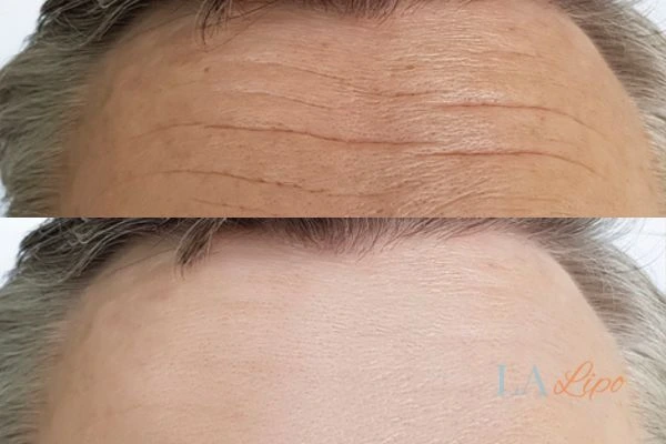 results of HIFU Cockfosters on mans forehead to help reduce lines and wrinkles