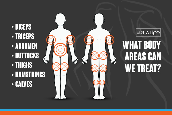 Graphic to show areas you can have LA-EMS Body Sculpting Cockfosters treatment.