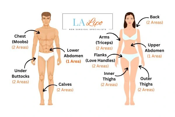 LA LIPO Cryolipolysis Areas Cockfosters
