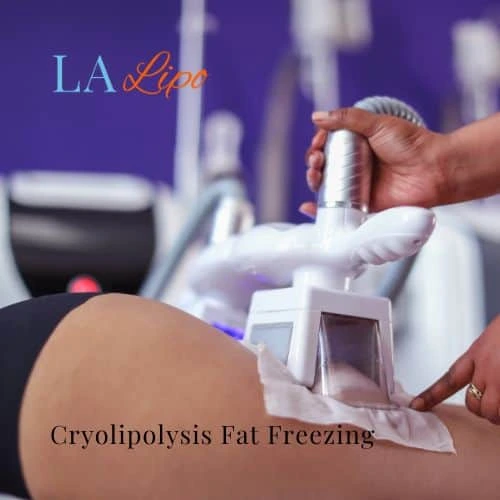 fat freezing - Cryolipolysis Cockfosters