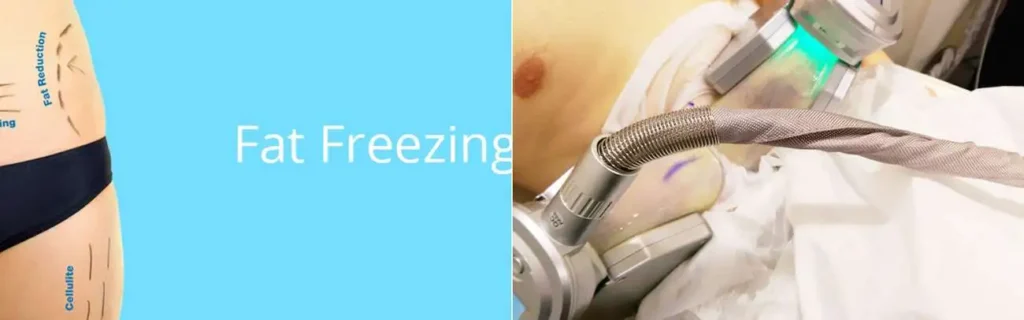 multi areas of a persons body having coolsculpting Cockfosters treatment