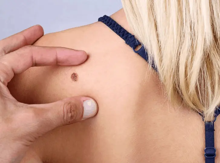 woman having mole removal Cockfosters consultation before treatment.