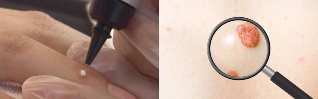 Person getting moles removed with cryopen Cockfosters