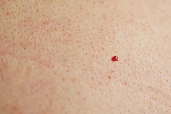 close up of a cherry angioma Cockfosters