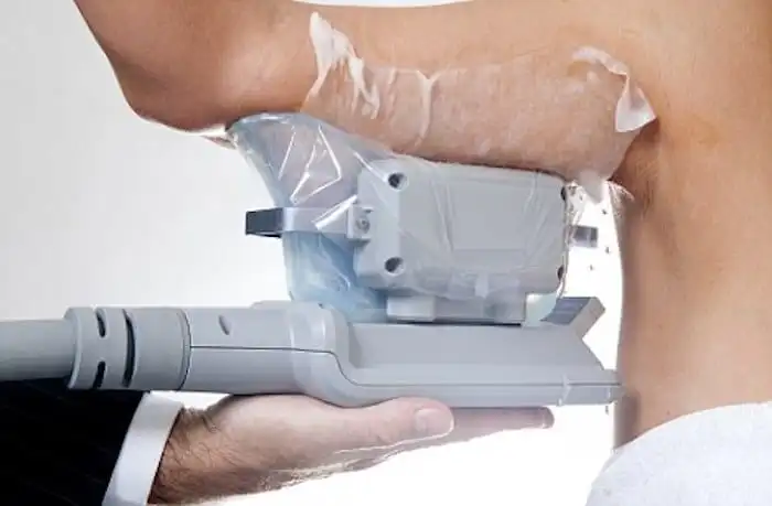 Picture of fat freezing Cockfosters on the upper arms.