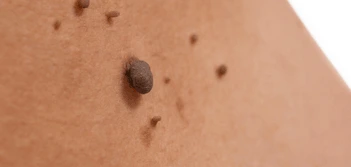 image of a skin tag Cockfosters