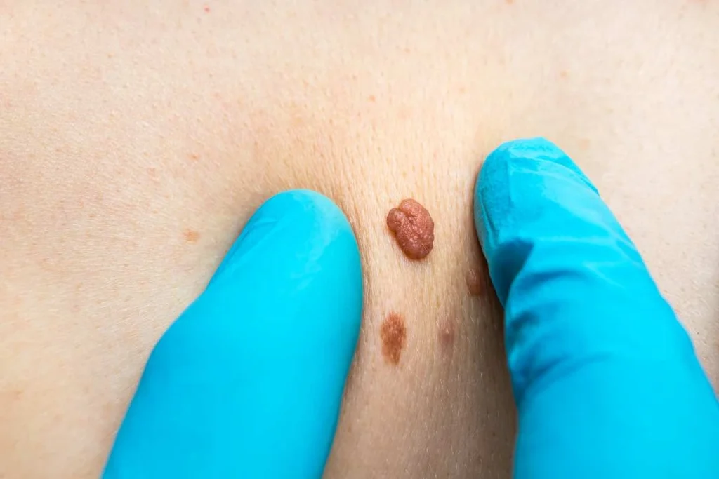 Consultant examining a skin tag Cockfosters