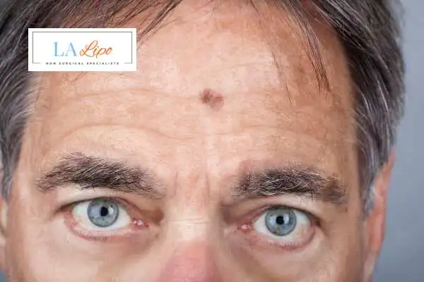Solar Lentigo Removal Cockfosters image of man with mark on his forehead