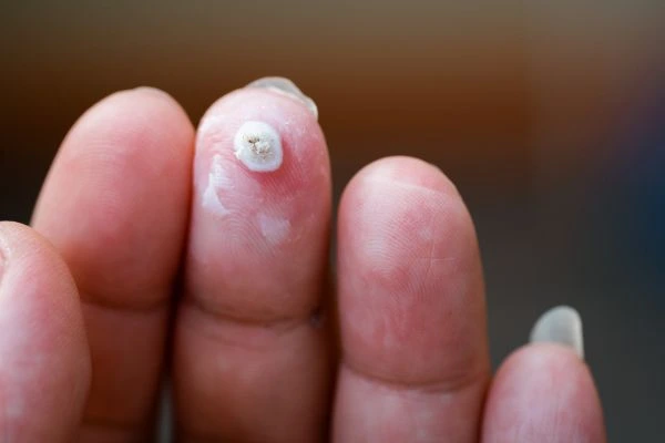 wart on person finger - cryotherapy to treat from LA LIPO Cockfosters