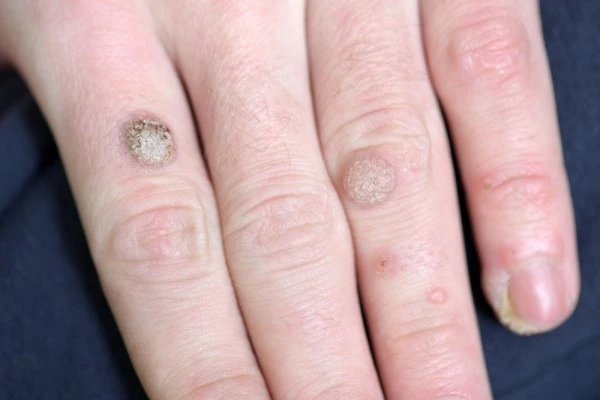 photo of warts on person hand - see wart removal Cockfosters from LA LIPO