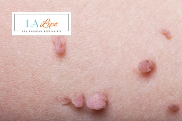 Does cryopen skin tag removal Cockfosters hurt? Find out now call our team today!