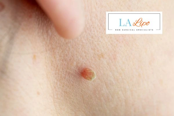 Book skin tag removal Cockfosters today speak to our team now!