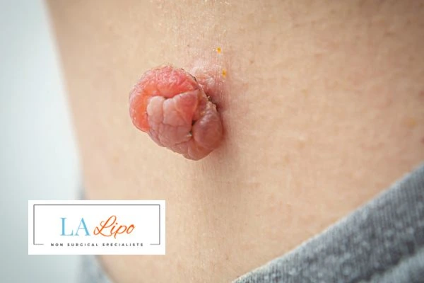 Interested in skin tag removal Cockfosters? Concerned about the pain? Find out more today!