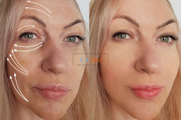 Morpheus 8 results Cockfosters face lift.
