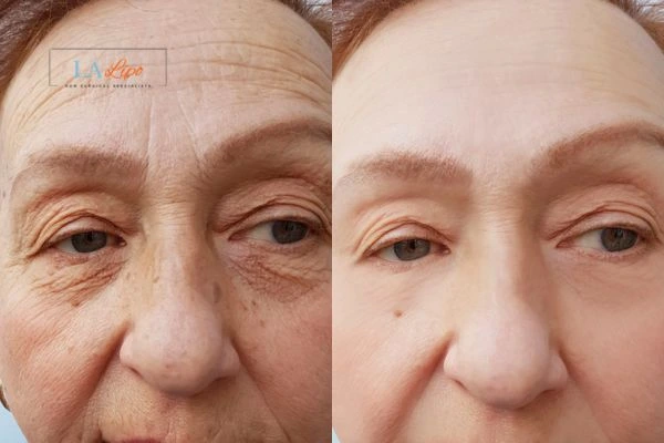 The powerful benefits of Morpheus8 Treatment Cockfosters - Call Our team today!