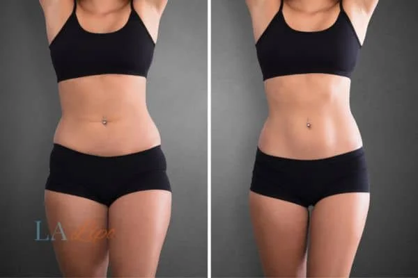 before and after results of non-surgical treatment to help a woman's body image and mental health Cockfosters