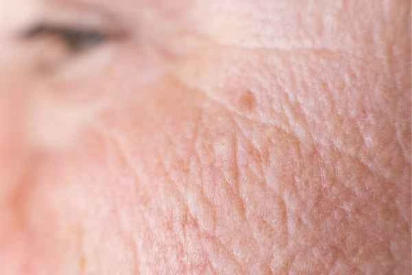 close up picture of a woman's face showing an age spot Cockfosters
