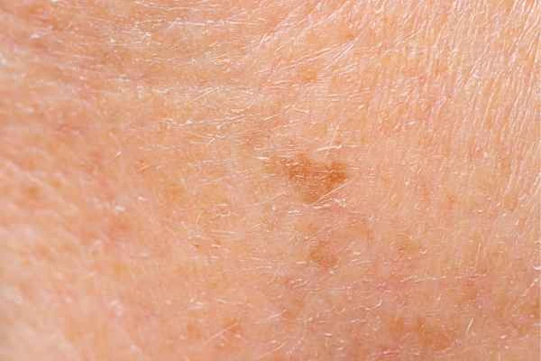 close up picture of age spots Cockfosters