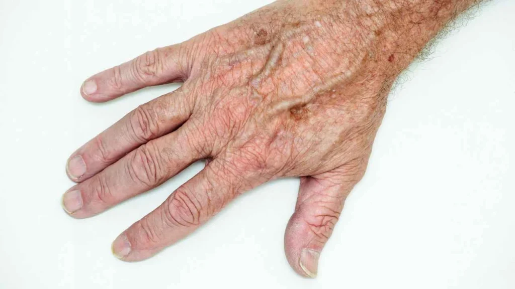 Male hand showing age spot Cockfosters