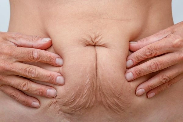 Image of a woman's stomach with loose skin - example of skin tightening Cockfosters options