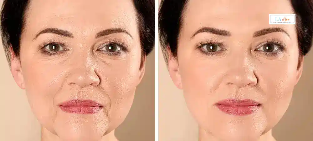 How Long Does It Take to See Results and How Long Do They Last Cockfosters?