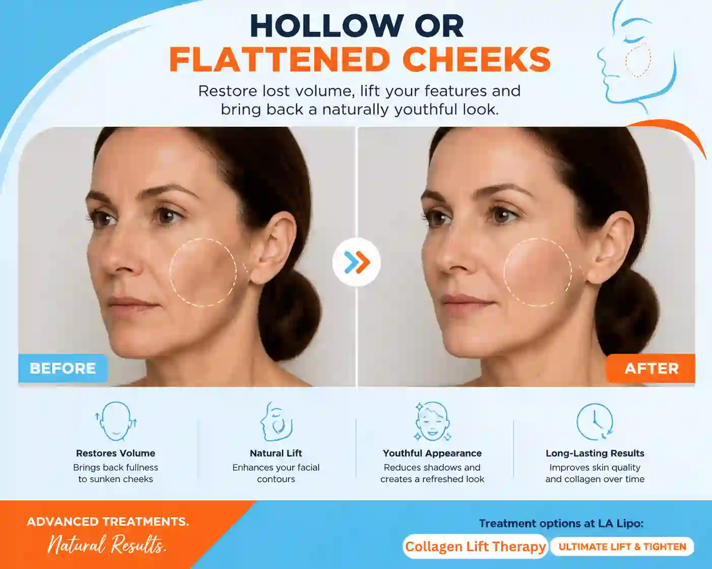Sign #4: Hollow or Flattened Cheeks Cockfosters