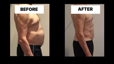 What Symptoms Can Diastasis Recti Cause in Men? Weak Core, Back Pain and Poor Posture Cockfosters